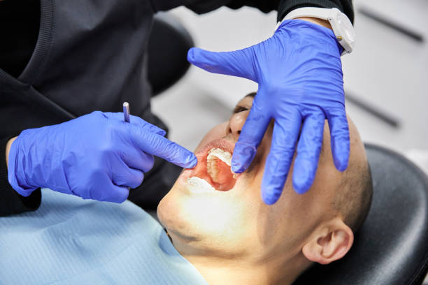 Best Emergency Wisdom Teeth Removal in Mission Nyon, CA