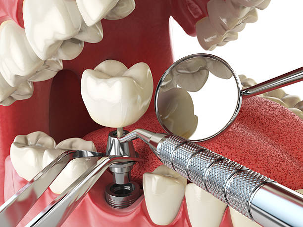 Best Emergency Root Canal Treatment in Mission Nyon, CA