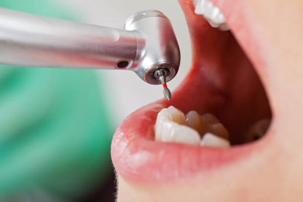 Best Emergency Treatment for Toothache in Mission Nyon, CA
